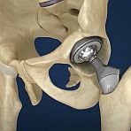 Image - Hip Implant Production That's 